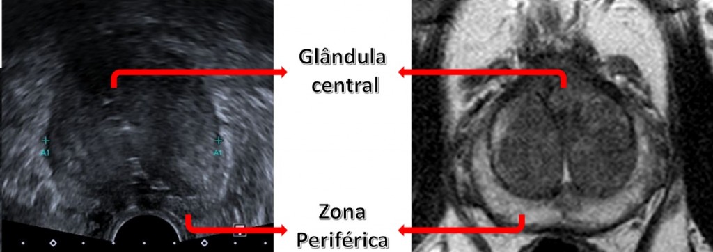 histología de la próstata marcada